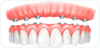 implant dentaire tunis