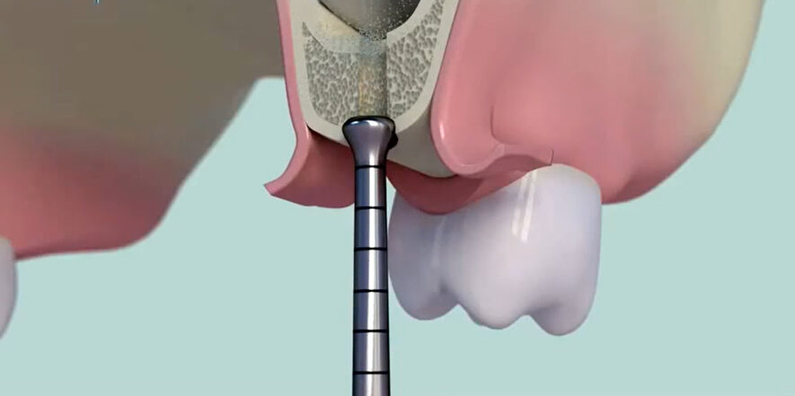 Piezochirurgie-Dentiste