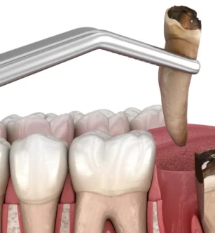 extraction-simple-dent