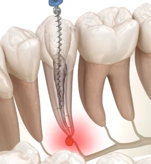 traitement-canal-dentaire