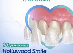 Facette dentaire prix Tunisie et offre promotionnelle