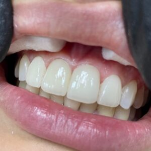 facette dentaire (1)