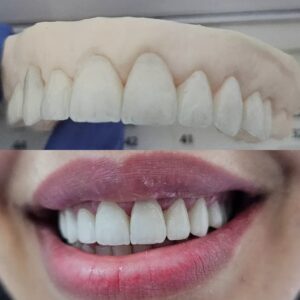 facette dentaire (3)