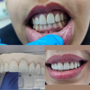 facette dentaire (4)