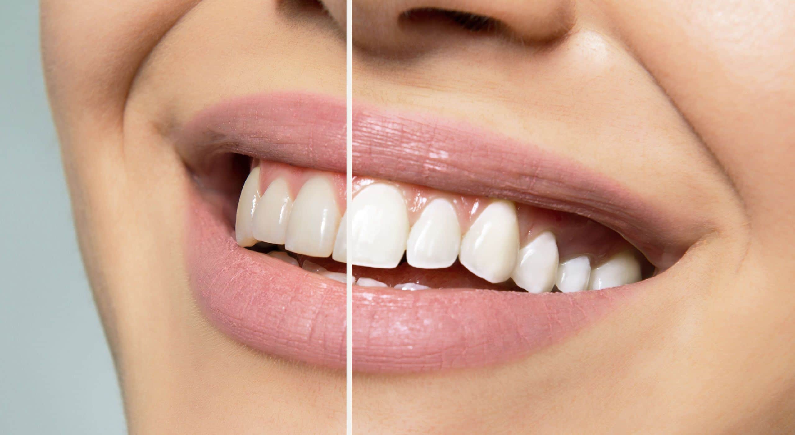 blanchiment dentaire à tunis