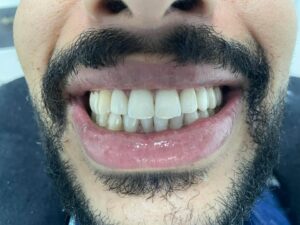 facettes dentaire (2)