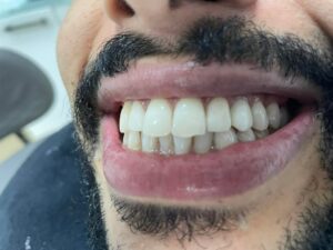 facettes dentaire (3)