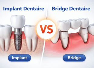 implant ou bridge